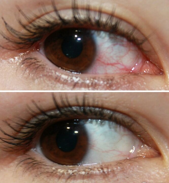 Az Ocuvit nagyon gyorsan működik