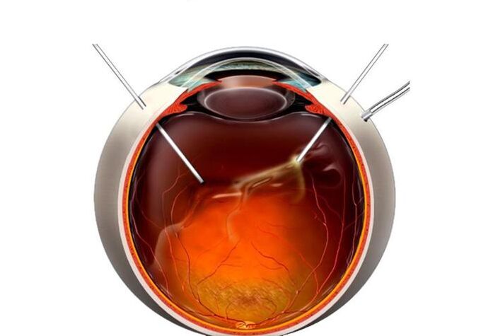Vitrectomy - A látás helyreállítására szolgáló művelet